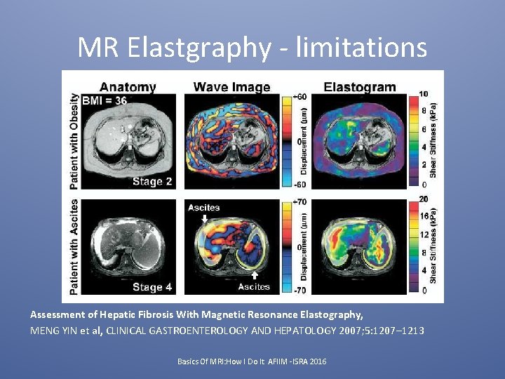 MR Elastgraphy - limitations Assessment of Hepatic Fibrosis With Magnetic Resonance Elastography, MENG YIN