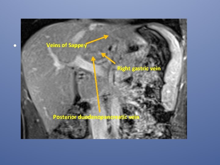 Veins of Sappey • the accessory portal system of Sappey, branches of which pass