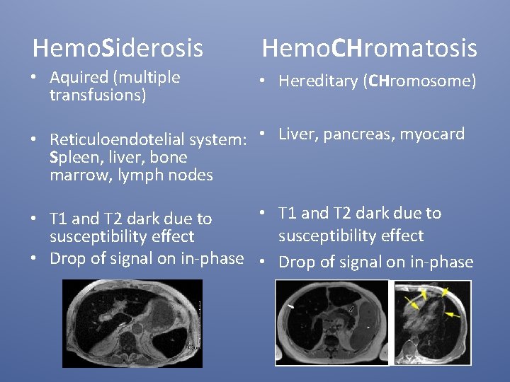 Hemo. Siderosis Hemo. CHromatosis • Aquired (multiple transfusions) • Hereditary (CHromosome) • Reticuloendotelial system: