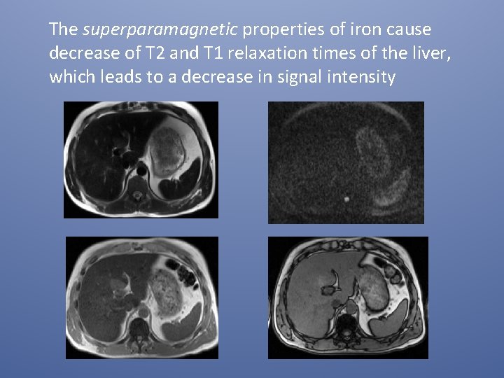 The superparamagnetic properties of iron cause decrease of T 2 and T 1 relaxation