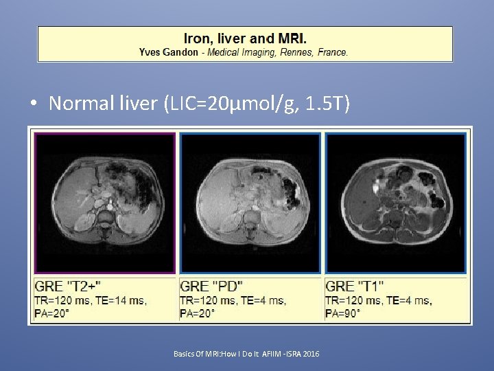  • Normal liver (LIC=20µmol/g, 1. 5 T) Basics Of MRI: How I Do