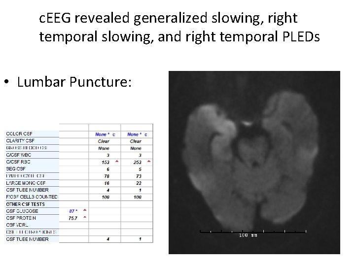 c. EEG revealed generalized slowing, right temporal slowing, and right temporal PLEDs • Lumbar