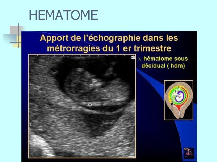 HEMATOME n 