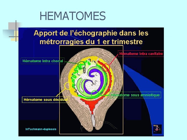 HEMATOMES n 