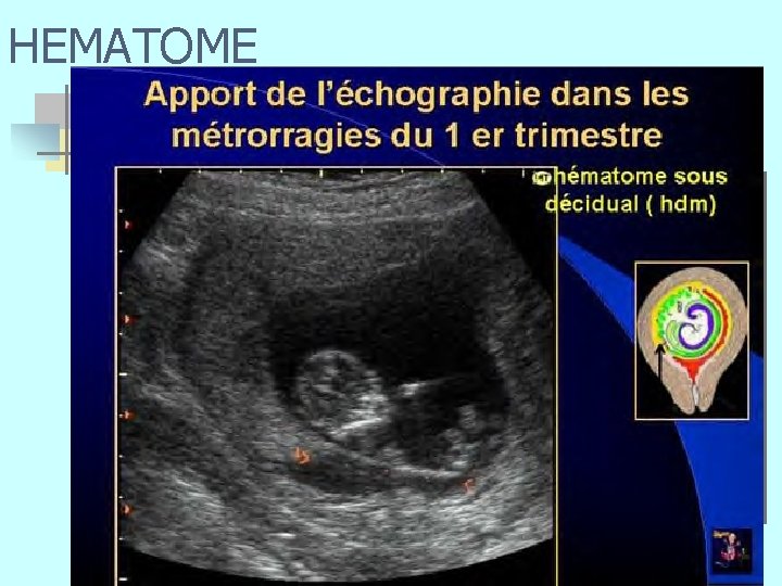 HEMATOME n 