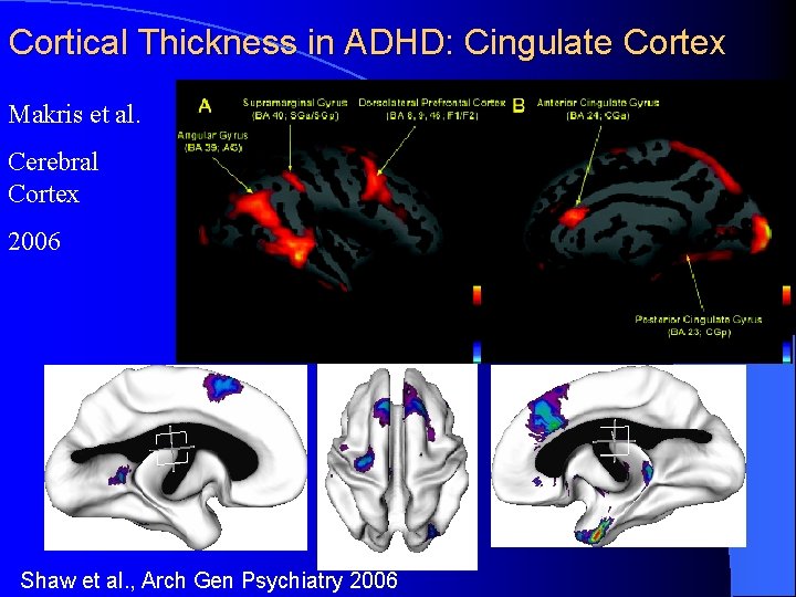 Cortical Thickness in ADHD: Cingulate Cortex Makris et al. Cerebral Cortex 2006 Shaw et