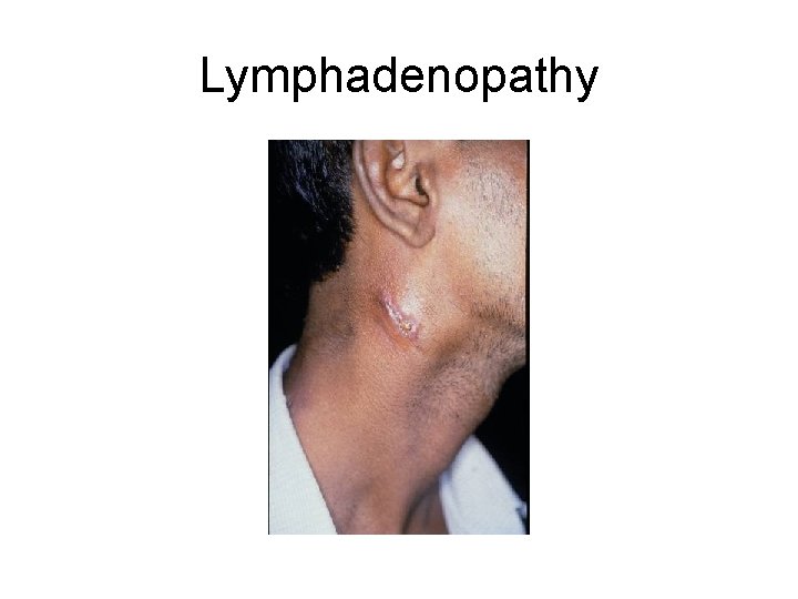 Lymphadenopathy 