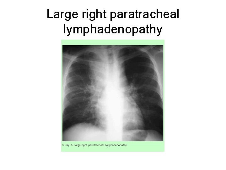 Large right paratracheal lymphadenopathy 