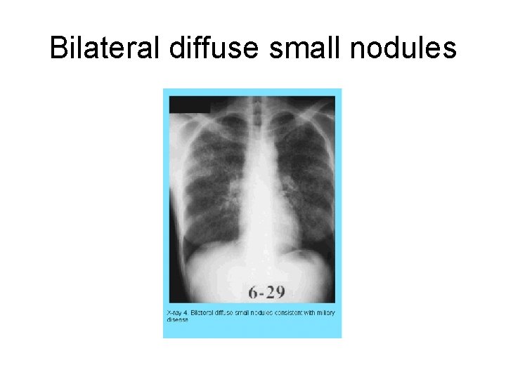 Bilateral diffuse small nodules 