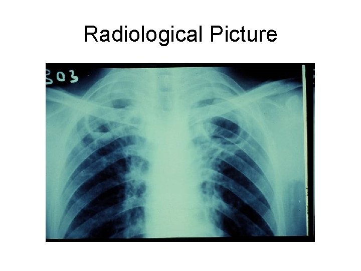 Radiological Picture 