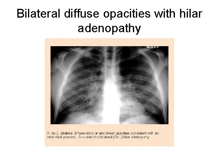 Bilateral diffuse opacities with hilar adenopathy 