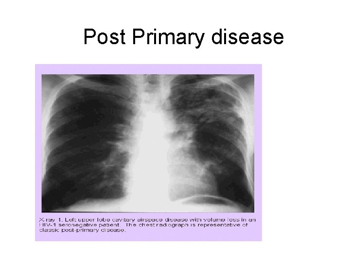 Post Primary disease 