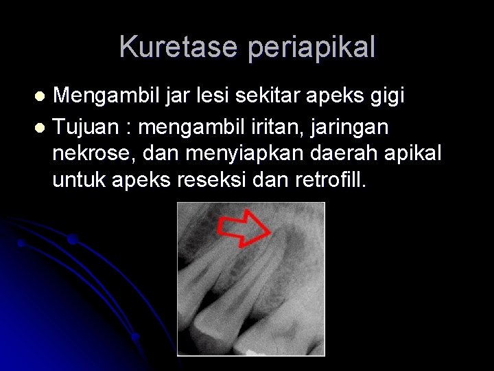 Kuretase periapikal Mengambil jar lesi sekitar apeks gigi l Tujuan : mengambil iritan, jaringan
