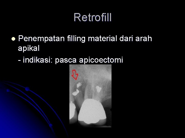 Retrofill l Penempatan filling material dari arah apikal - indikasi: pasca apicoectomi 