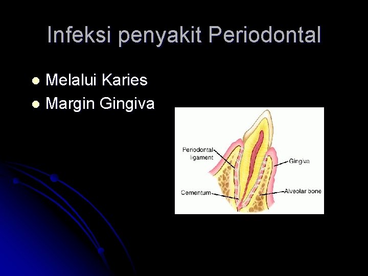 Infeksi penyakit Periodontal Melalui Karies l Margin Gingiva l 