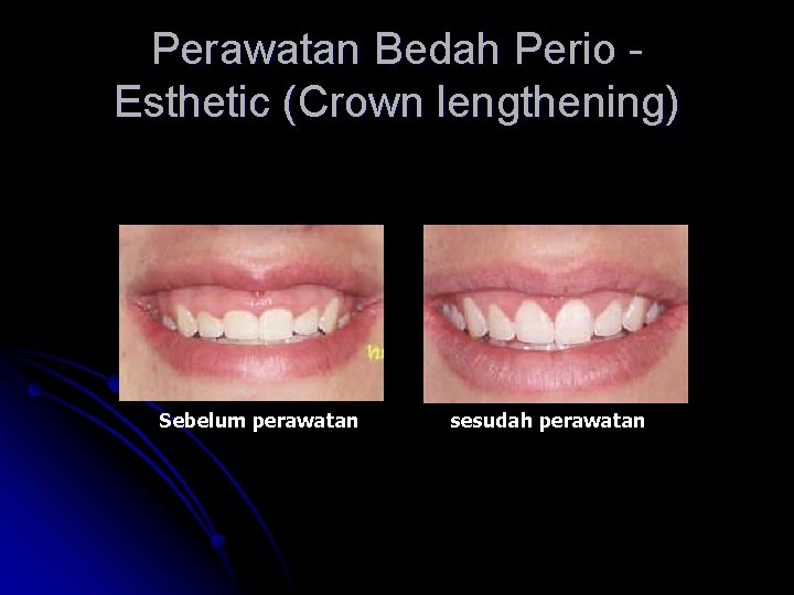 Perawatan Bedah Perio Esthetic (Crown lengthening) Sebelum perawatan sesudah perawatan 