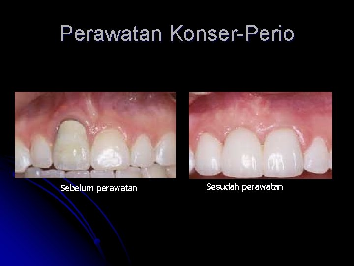 Perawatan Konser-Perio Sebelum perawatan Sesudah perawatan 