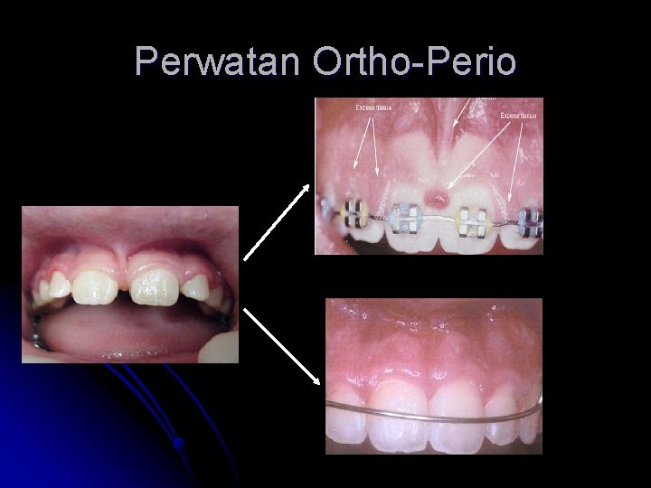 Perwatan Ortho-Perio 