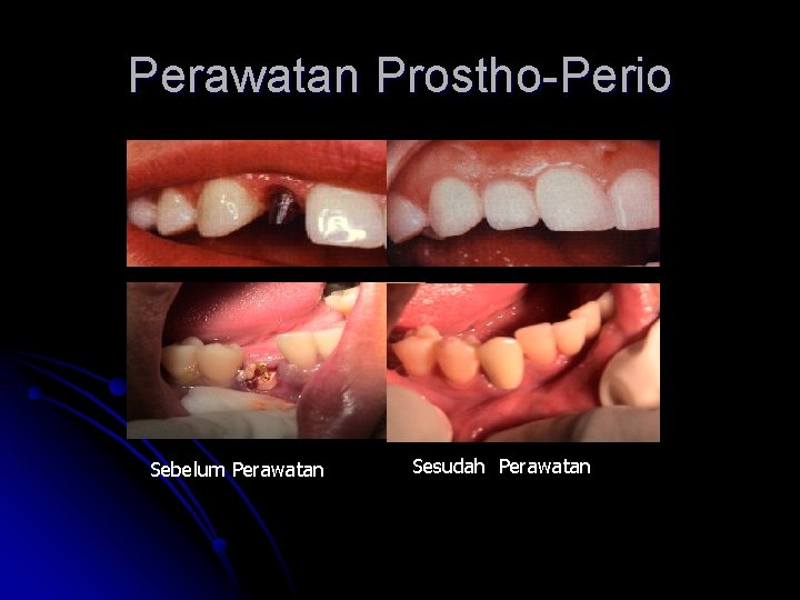 Perawatan Prostho-Perio Sebelum Perawatan Sesudah Perawatan 