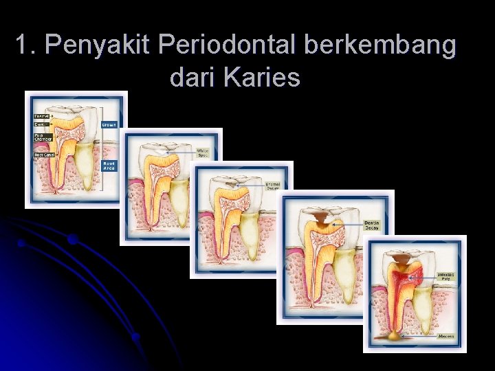 1. Penyakit Periodontal berkembang dari Karies 