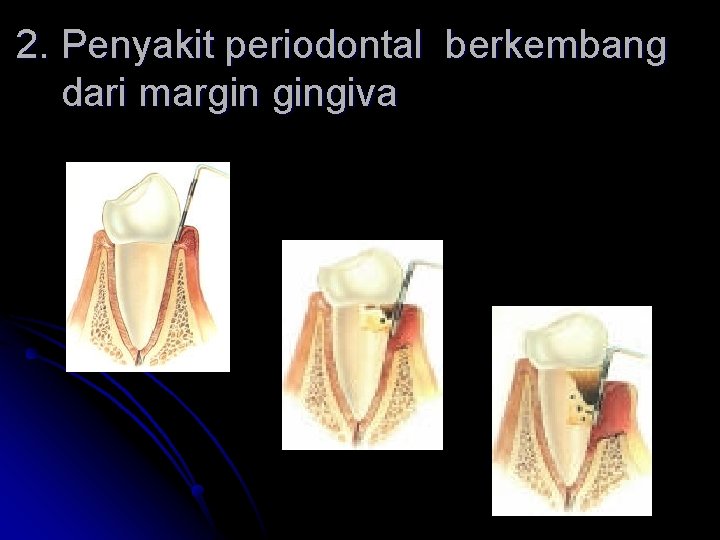 2. Penyakit periodontal berkembang dari margin gingiva 