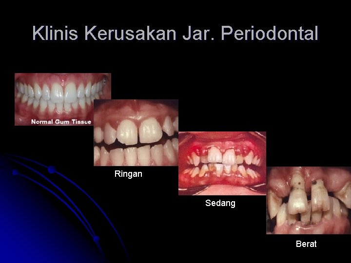 Klinis Kerusakan Jar. Periodontal Ringan Sedang Berat 