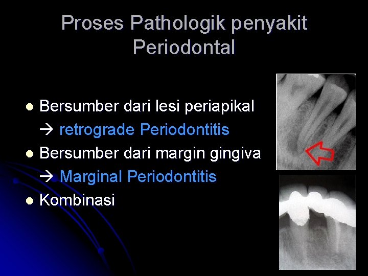 Proses Pathologik penyakit Periodontal Bersumber dari lesi periapikal retrograde Periodontitis l Bersumber dari margin