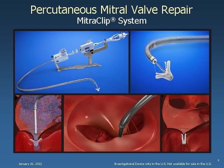 Percutaneous Mitral Valve Repair Mitra. Clip® System 3 January 16, 2012 Investigational Device only