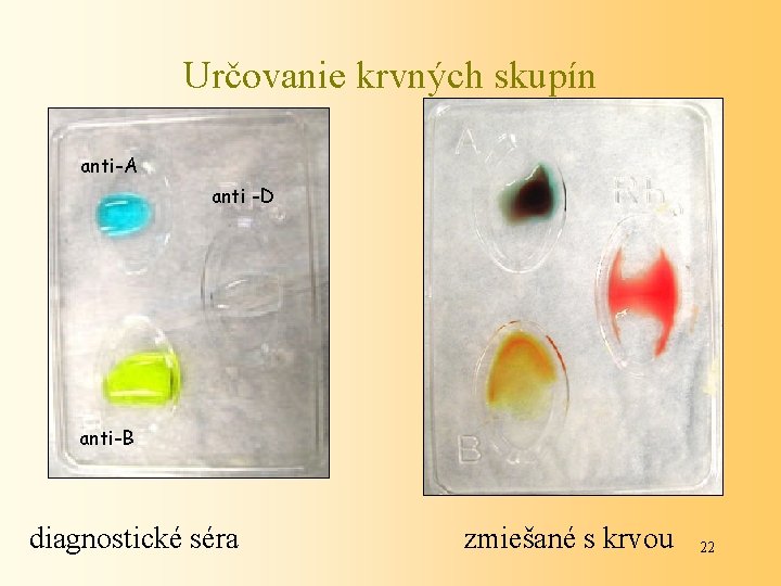 Určovanie krvných skupín anti-A anti -D anti-B diagnostické séra zmiešané s krvou 22 