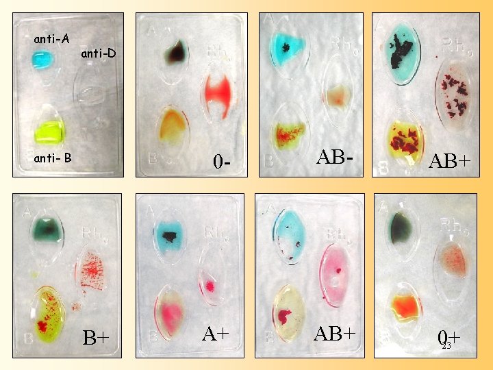 anti-A anti-D anti- B B+ 0 - AB+ A+ AB+ 0+ 23 