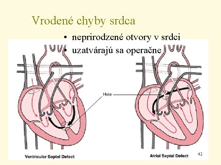 Vrodené chyby srdca • neprirodzené otvory v srdci • uzatvárajú sa operačne 42 