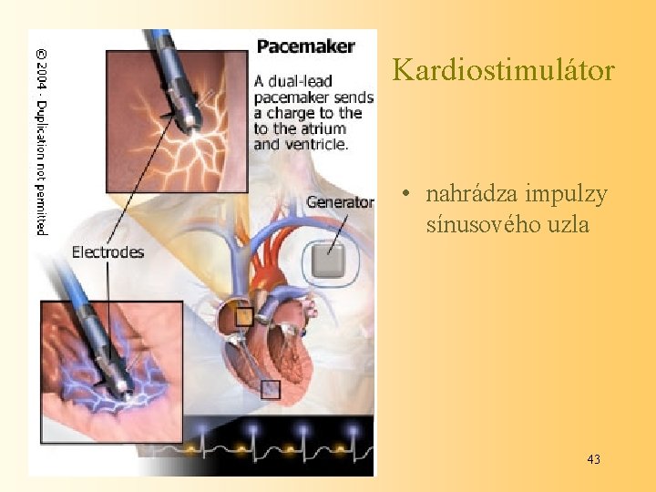 Kardiostimulátor • nahrádza impulzy sínusového uzla 43 
