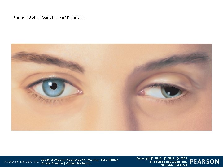 Figure 15. 44 Cranial nerve III damage. Health & Physical Assessment in Nursing, Third