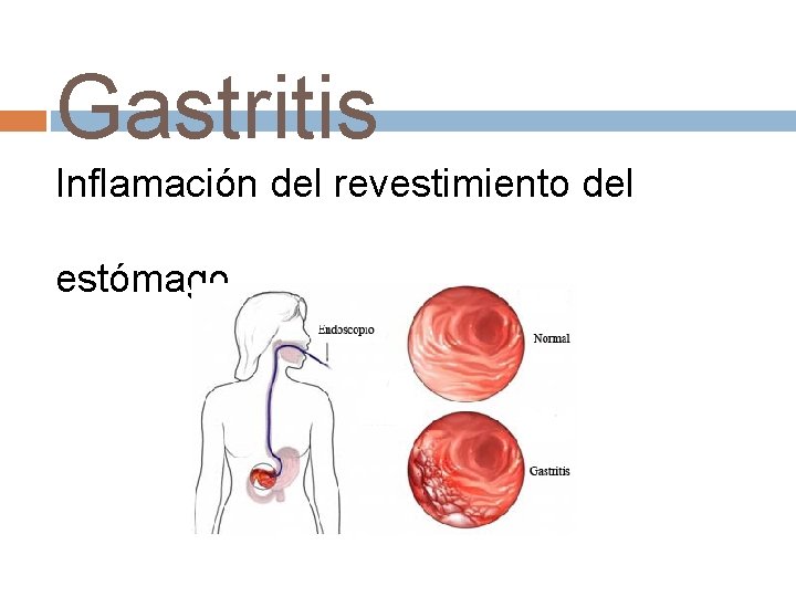 Gastritis Inflamación del revestimiento del estómago. 