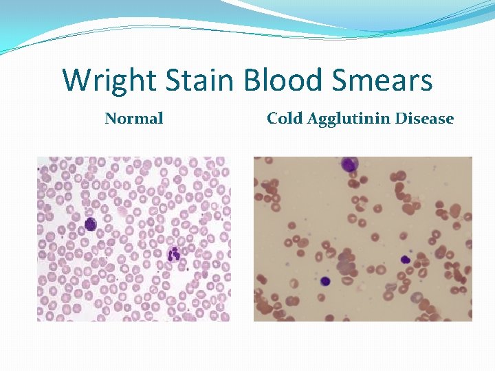 Wright Stain Blood Smears Normal Cold Agglutinin Disease 