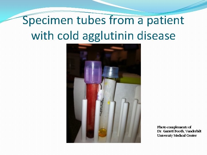 Specimen tubes from a patient with cold agglutinin disease Photo complements of Dr. Garrett