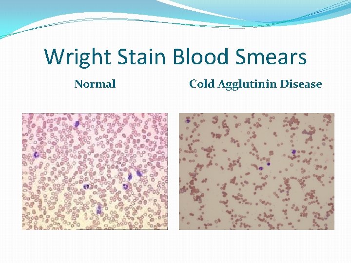 Wright Stain Blood Smears Normal Cold Agglutinin Disease 