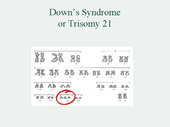 Down’s Syndrome or Trisomy 21 