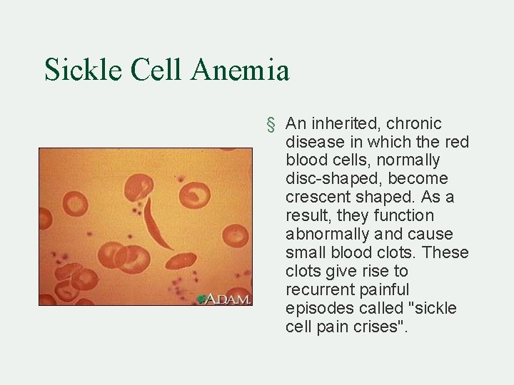 Sickle Cell Anemia § An inherited, chronic disease in which the red blood cells,
