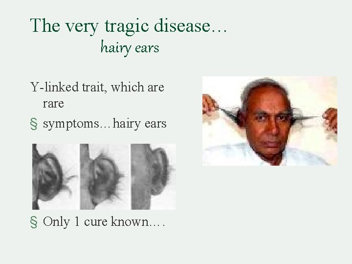 The very tragic disease… hairy ears Y-linked trait, which are rare § symptoms…hairy ears
