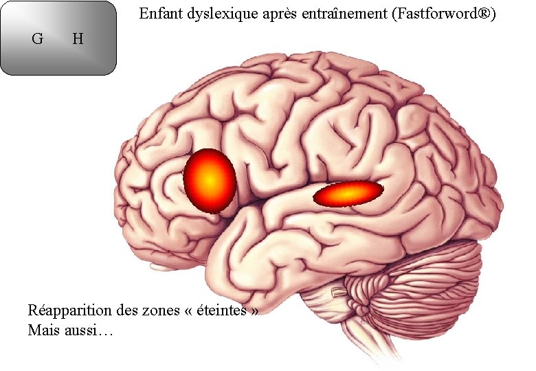 Enfant dyslexique après entraînement (Fastforword®) G H Réapparition des zones « éteintes » Mais