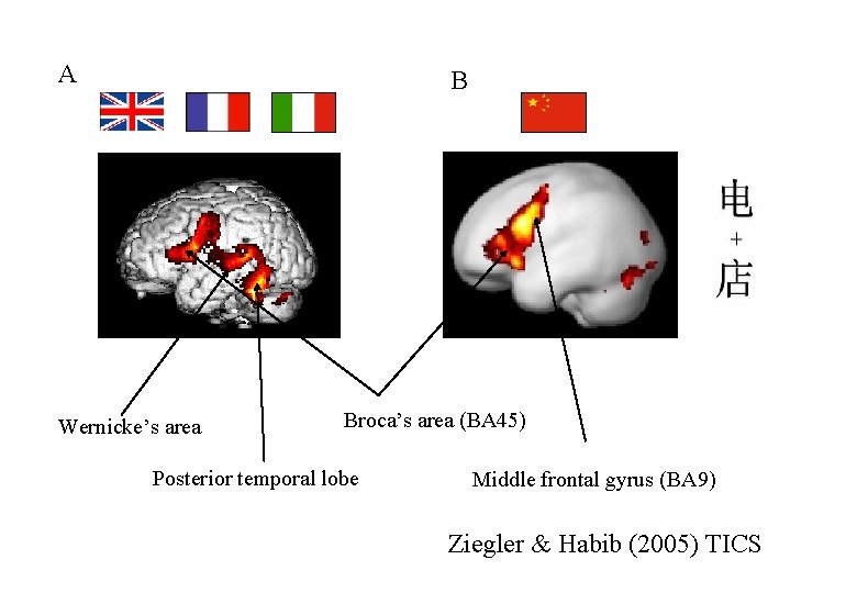 A B Wernicke’s area Broca’s area (BA 45) Posterior temporal lobe Middle frontal gyrus