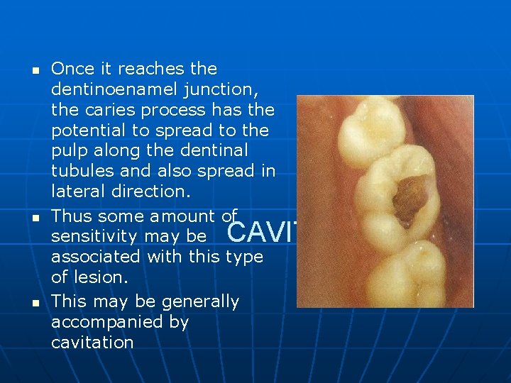 n n n Once it reaches the dentinoenamel junction, the caries process has the