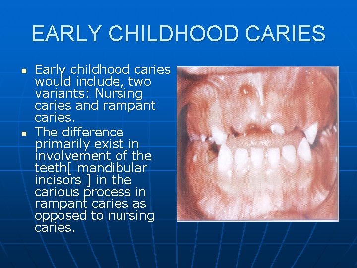 EARLY CHILDHOOD CARIES n n Early childhood caries would include, two variants: Nursing caries