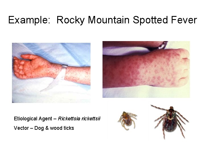 Example: Rocky Mountain Spotted Fever Etiological Agent – Rickettsia rickettsii Vector – Dog &