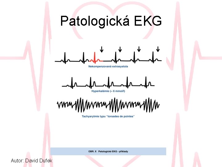 Patologická EKG Autor: David Dufek 