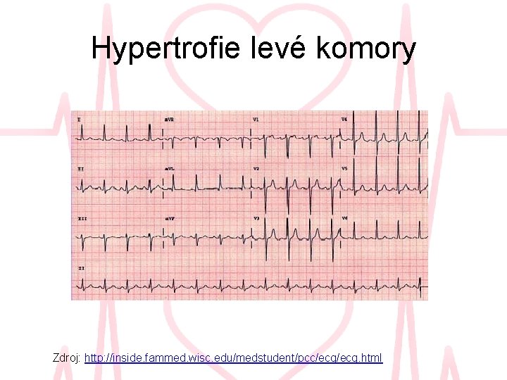 Hypertrofie levé komory Zdroj: http: //inside. fammed. wisc. edu/medstudent/pcc/ecg. html 