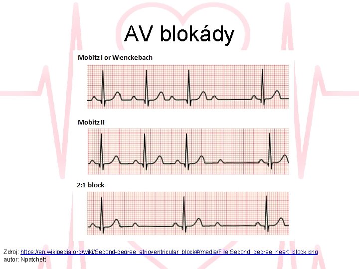 AV blokády Zdroj: https: //en. wikipedia. org/wiki/Second-degree_atrioventricular_block#/media/File: Second_degree_heart_block. png, autor: Npatchett 