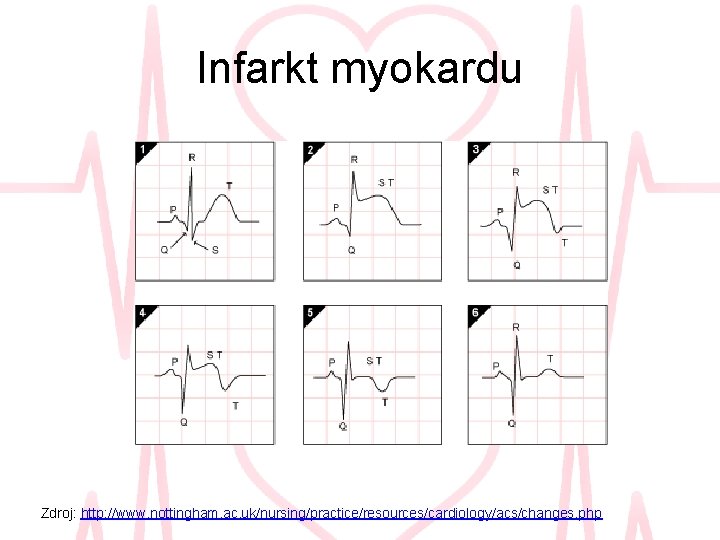 Infarkt myokardu Zdroj: http: //www. nottingham. ac. uk/nursing/practice/resources/cardiology/acs/changes. php 