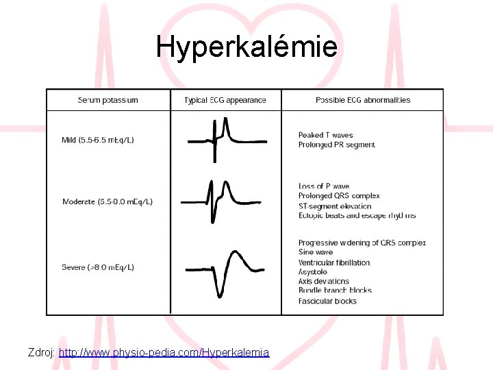 Hyperkalémie Zdroj: http: //www. physio-pedia. com/Hyperkalemia 